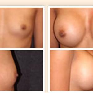 Breast Enhancement Pills Reviews - The Many Questions About Natural Breast Enhancement
