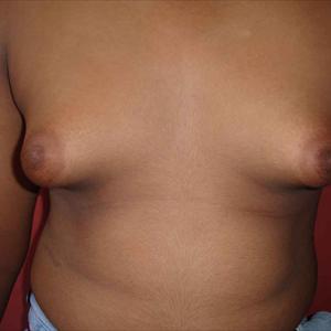 Boobs Enlargement - Breast Enhancement Herbs