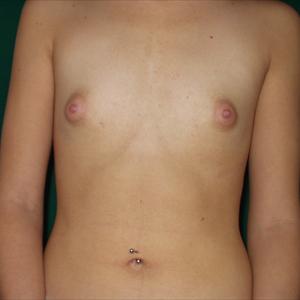 Breast Enhancement Surgery - Breast Enhancement And Enlargement Products